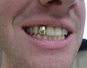 دندان طلا - خاصیت درمانی طلا